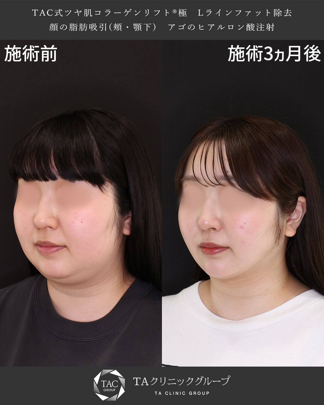 TAC式 ツヤ肌コラーゲンリフト®/顎下の脂肪吸引/Lラインファット除去（エラ下脂肪除去）の症例写真 施術前後 