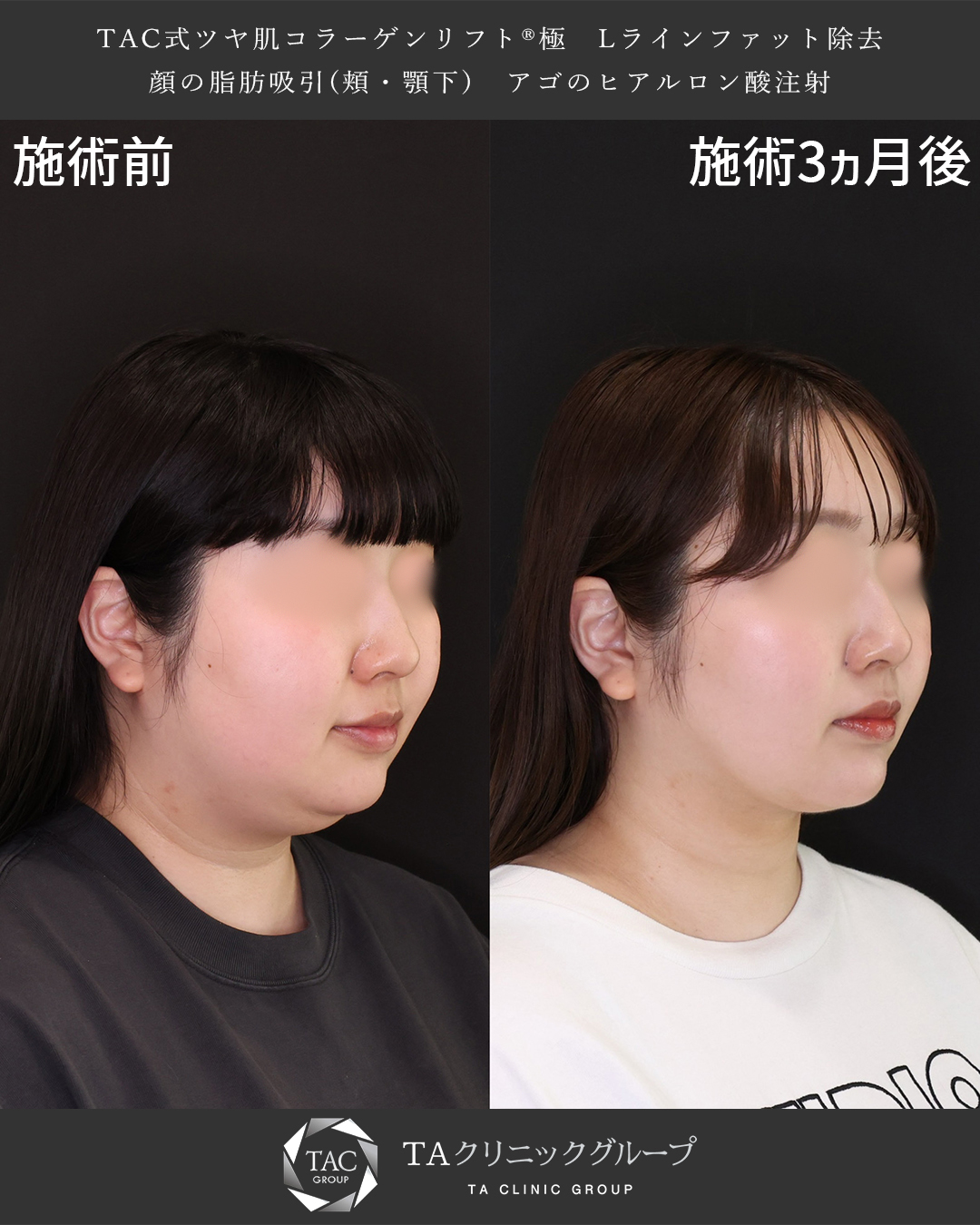 TAC式 ツヤ肌コラーゲンリフト®/顎下の脂肪吸引/Lラインファット除去（エラ下脂肪除去）の症例写真 施術前後 