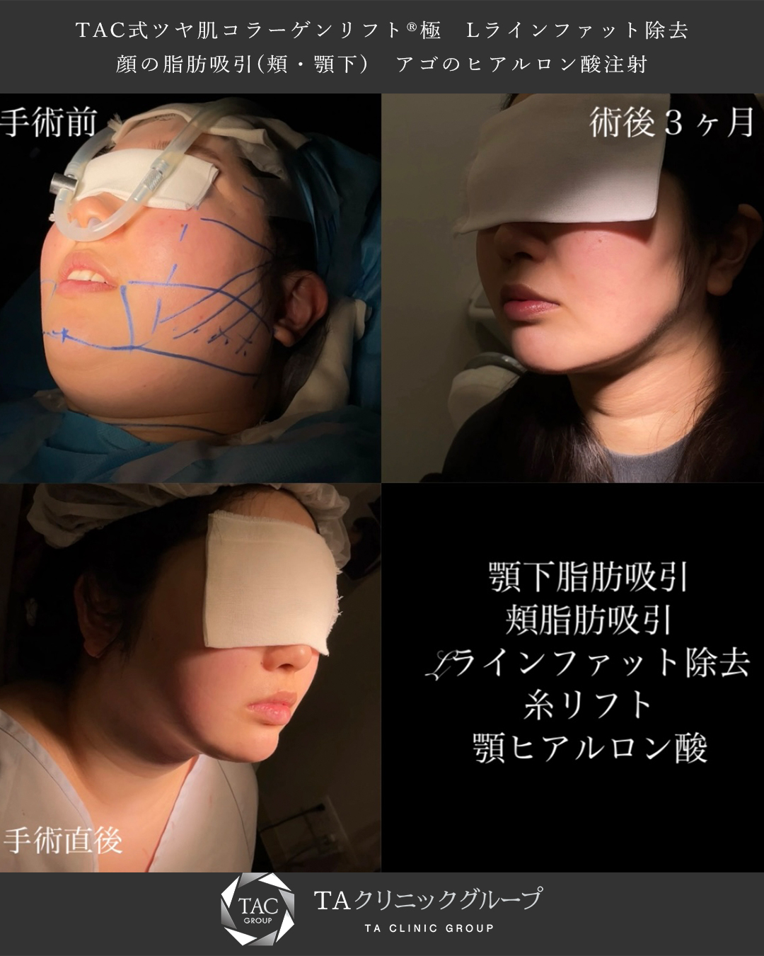 TAC式 ツヤ肌コラーゲンリフト®/顎下の脂肪吸引/Lラインファット除去（エラ下脂肪除去）の症例写真 施術前後 