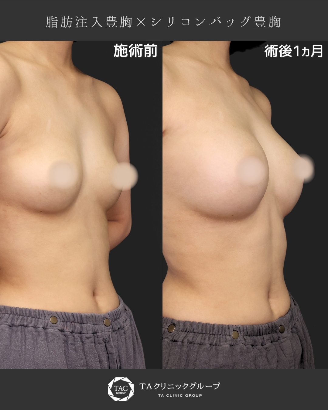 豊胸・バスト：その他/シリコンバッグ豊胸（人工乳腺バッグ）/脂肪注入豊胸（コンデンスリッチ・ピュアグラフト・１day脂肪豊胸）の症例写真 施術前後 