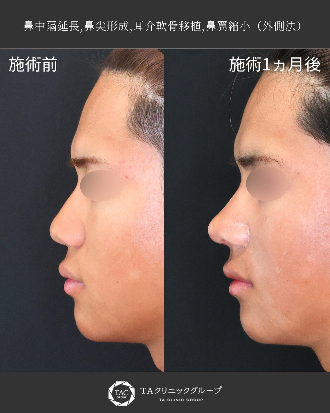 鼻中隔延長術/鼻尖形成・鼻尖縮小/TAC式 鼻翼縮小術（小鼻縮小）の症例写真 施術前後 