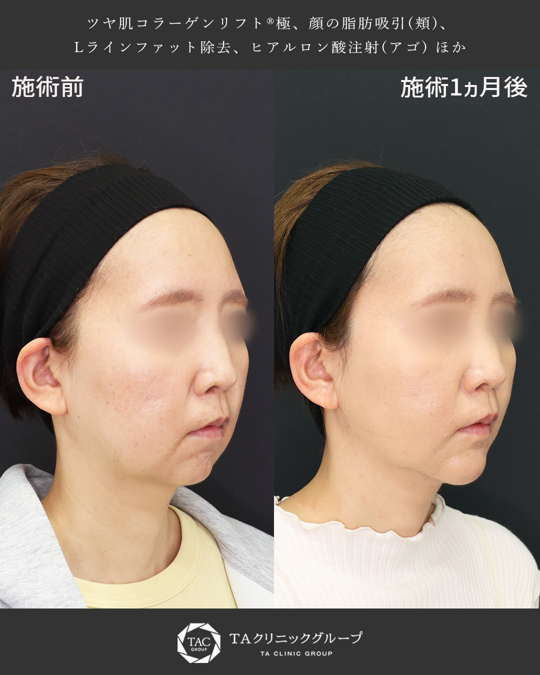 TAC式 ツヤ肌コラーゲンリフト®/顎下の脂肪吸引/Lラインファット除去（エラ下脂肪除去）の症例写真 施術前後 