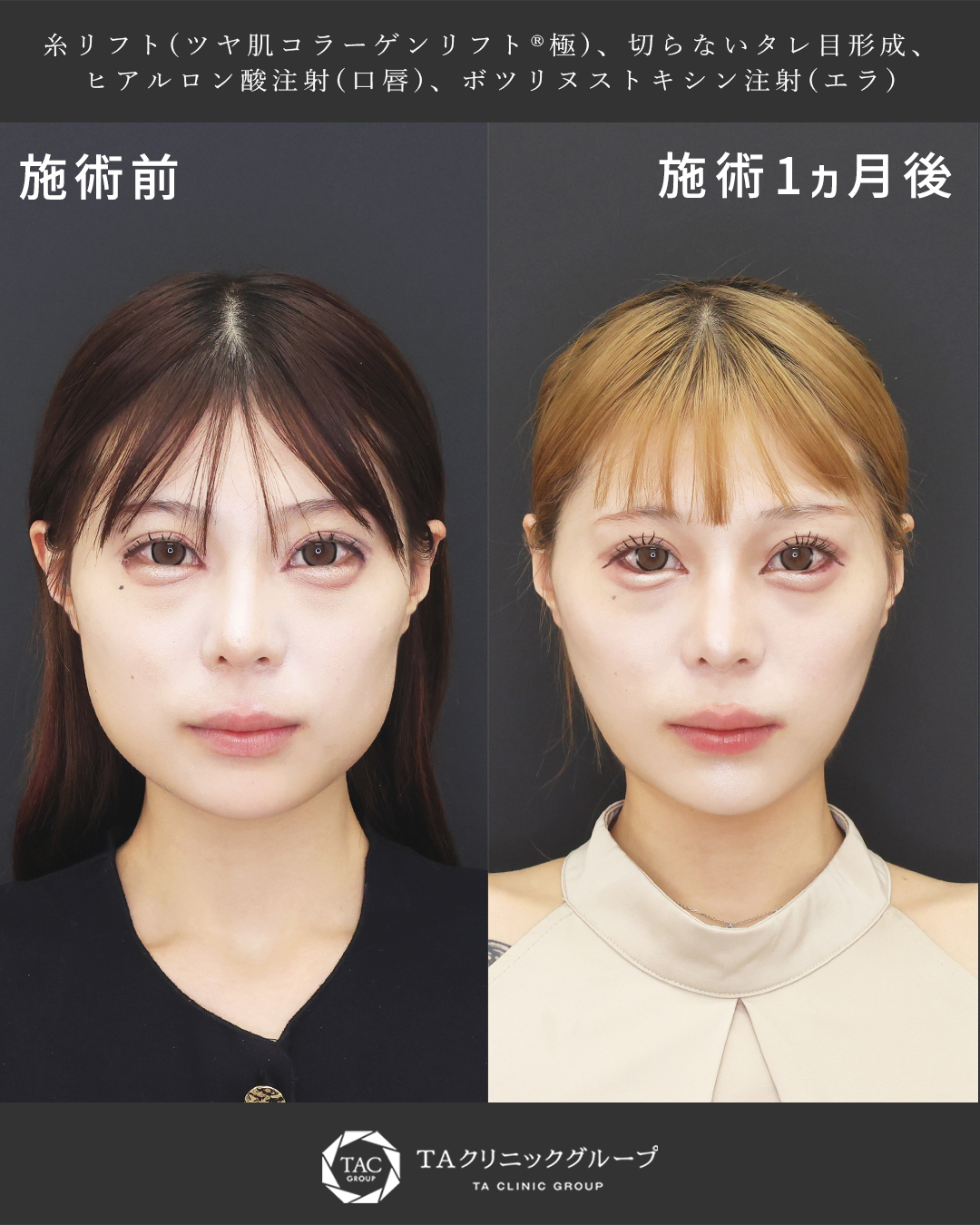 TAC式 ツヤ肌コラーゲンリフト®/グラマラスライン（タレ目形成）/エラボトックス注射の症例写真 施術前後 