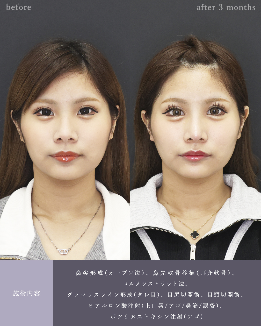 鼻尖形成・鼻尖縮小/鼻先軟骨移植/グラマラスライン（タレ目形成）の症例写真 施術前後 