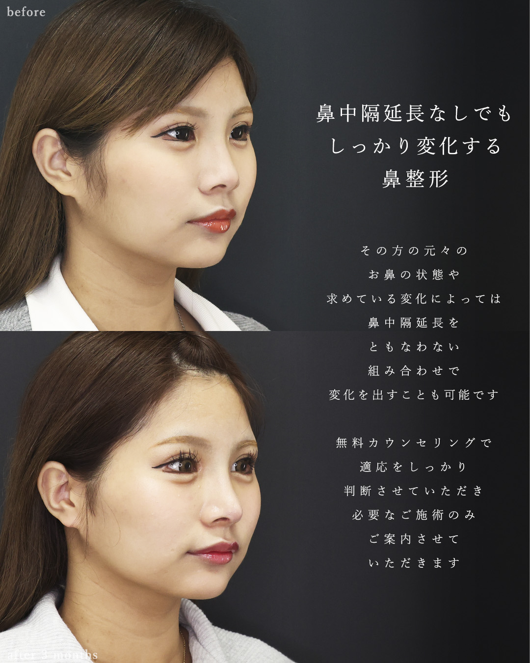 鼻尖形成・鼻尖縮小/鼻先軟骨移植/グラマラスライン（タレ目形成）の症例写真 施術前後 