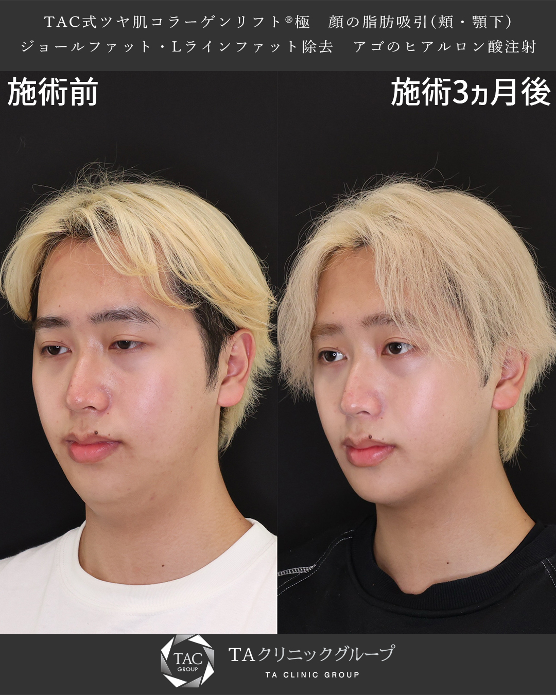 TAC式 ツヤ肌コラーゲンリフト®/Lラインファット除去（エラ下脂肪除去）/顎下の脂肪吸引の症例写真 施術前後 