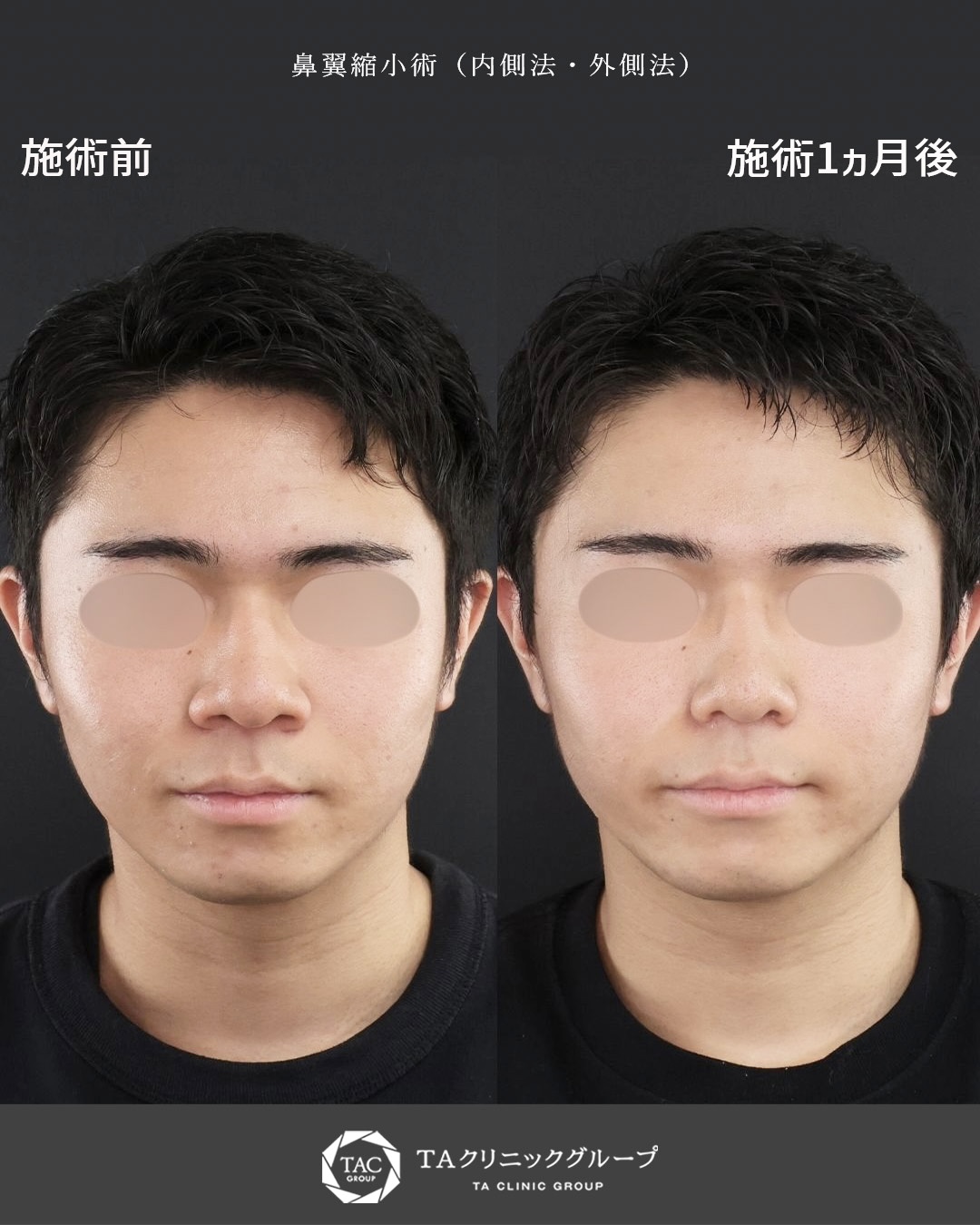 TAC式 鼻翼縮小術（小鼻縮小）の症例写真 施術前後 