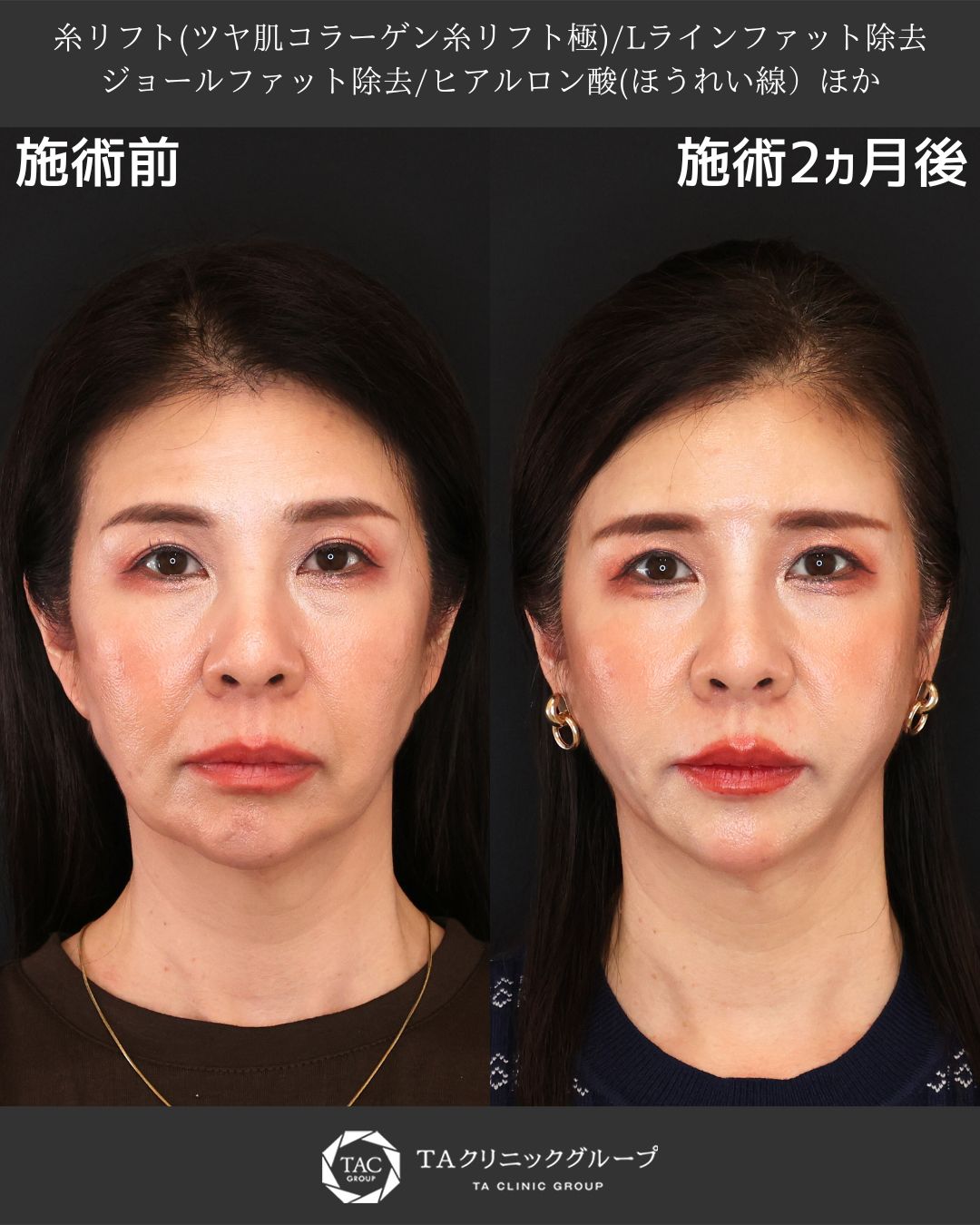 TAC式 ツヤ肌コラーゲンリフト®/Lラインファット除去（エラ下脂肪除去）/ジョールファット除去の症例写真 施術前後 
