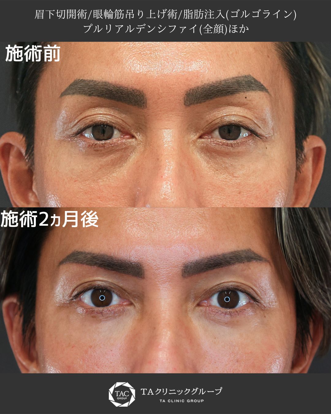 眉毛下切開術/顔の脂肪注入(コンデンスリッチフェイス)の症例写真 施術前後 