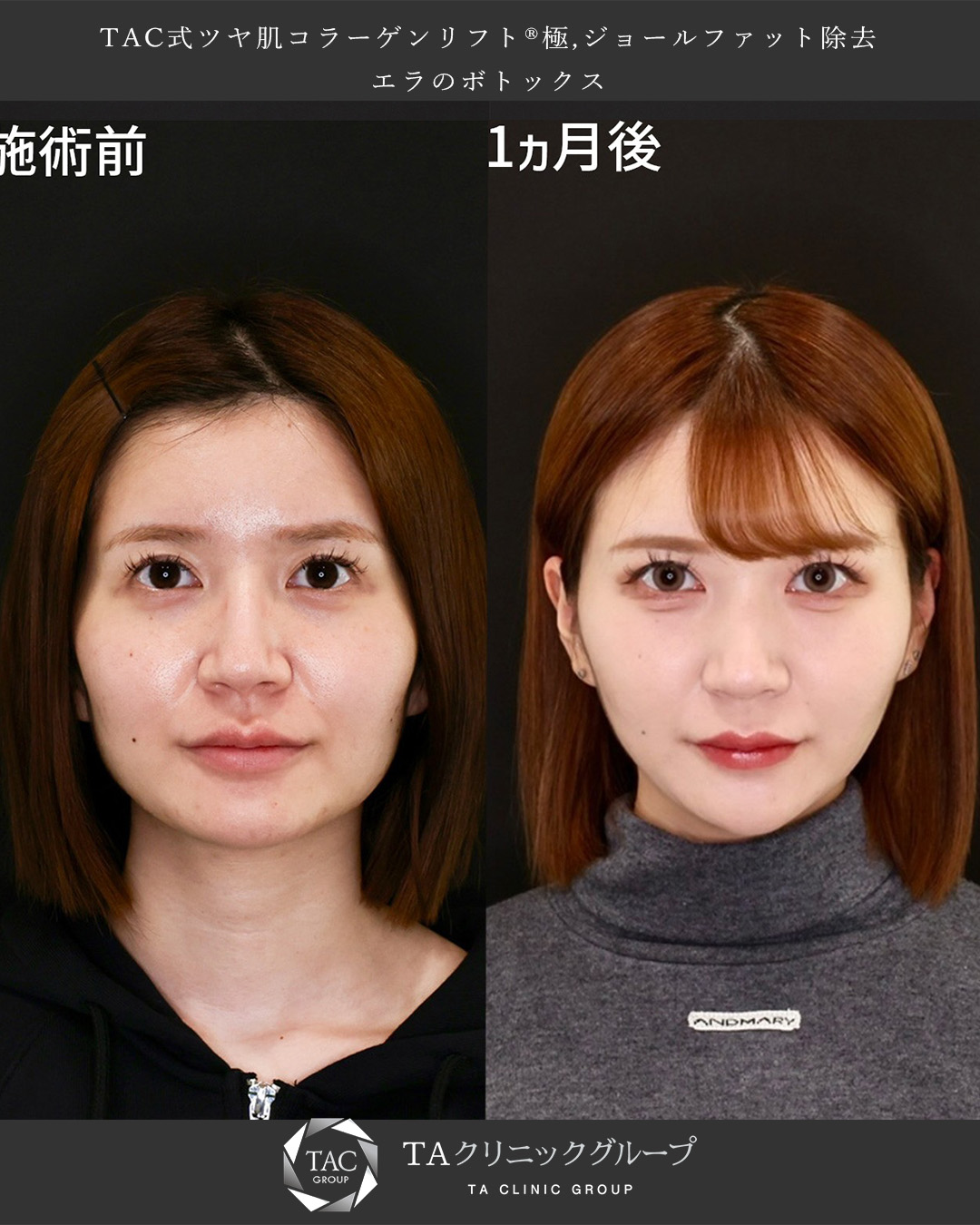 TAC式 ツヤ肌コラーゲンリフト®/エラボトックス注射/ジョールファット除去の症例写真 施術前後 