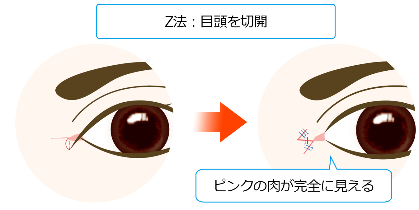 Z型形成(目頭切開Z法)とは