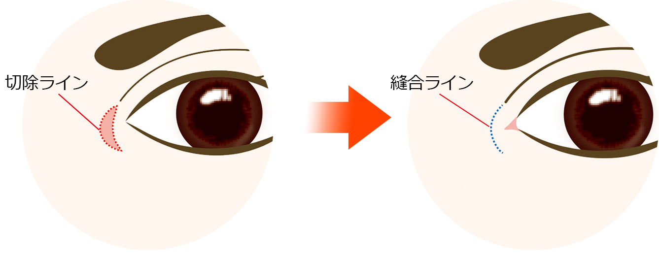 三日月皮膚切除法とは