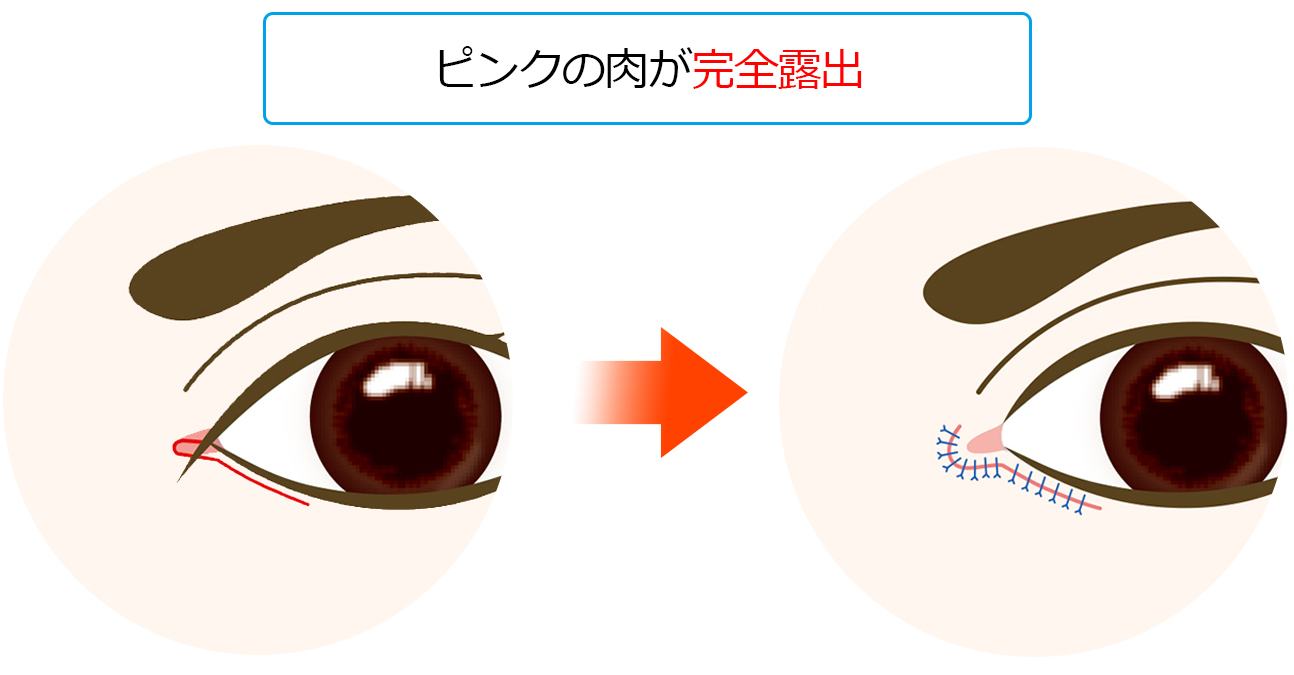 韓流切開法(リドレープ法)とは