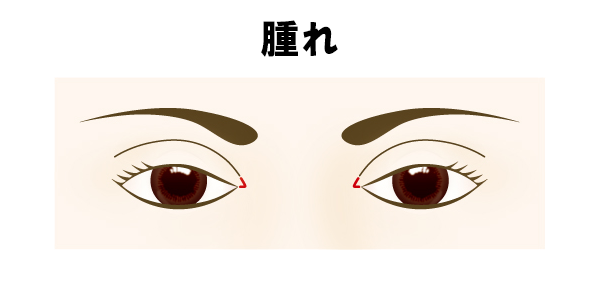 目頭切開の腫れ