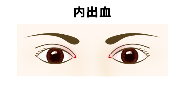 目頭切開の内出血